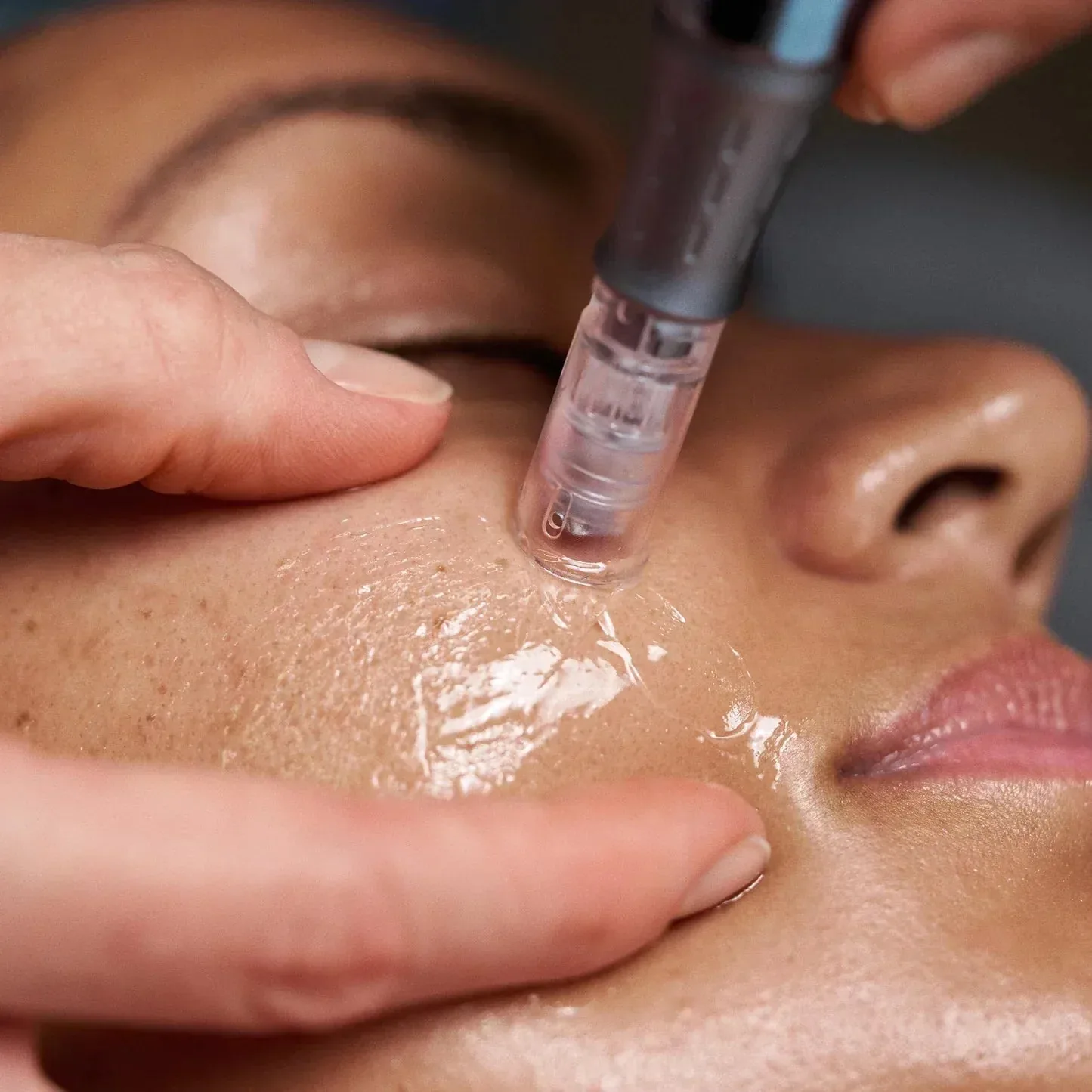 Exosome Facelift Facial NYC: Advanced No-Downtime Skin Renewal